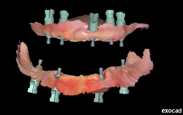 Digital Implant and Occlusal Reconstruction for Edentulous Patient Using Aoralscan Elite and MetiSmile