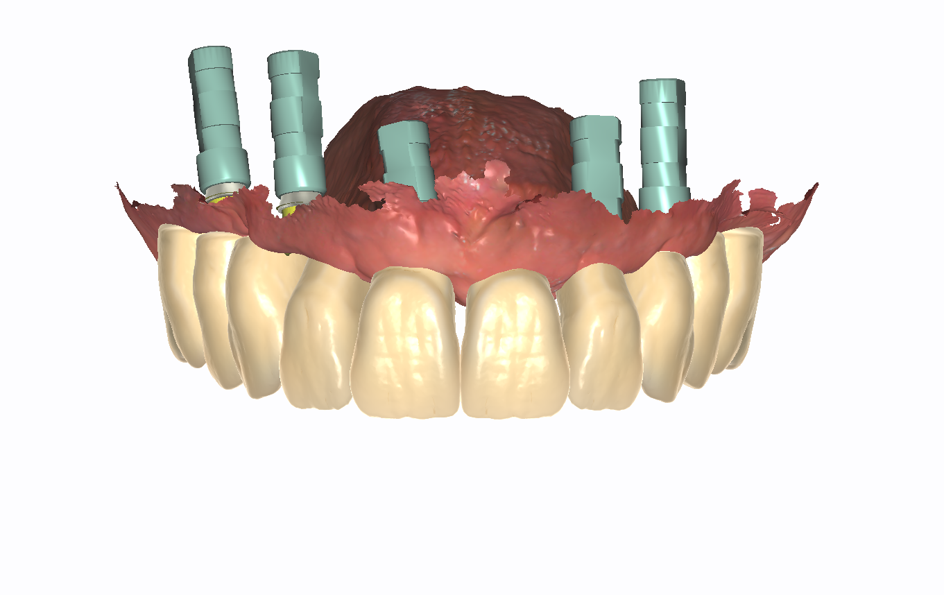 Digital Single Arch Implant Restoration