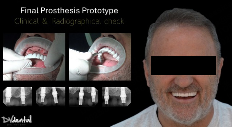 Edentulous Implant-Supported Occlusal Reconstruction Case Using Aoralscan Elite and MetiSmile
