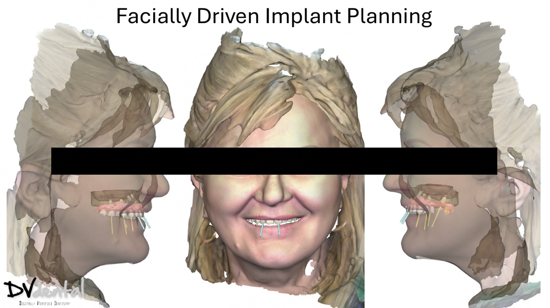 Facially-driven-implant-planning
