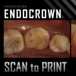 Endocrown Restoration