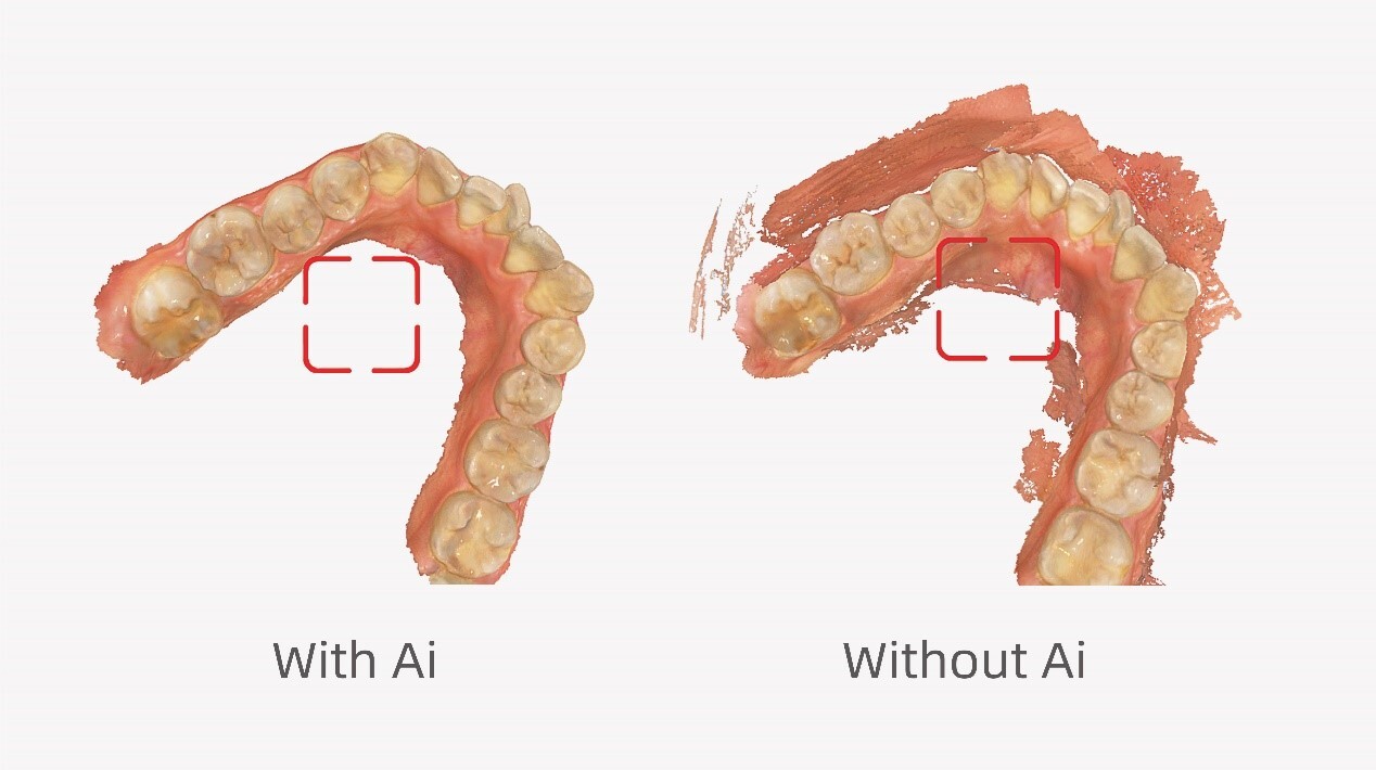 How Fast and Intelligent can the Aoralscan 3 be?