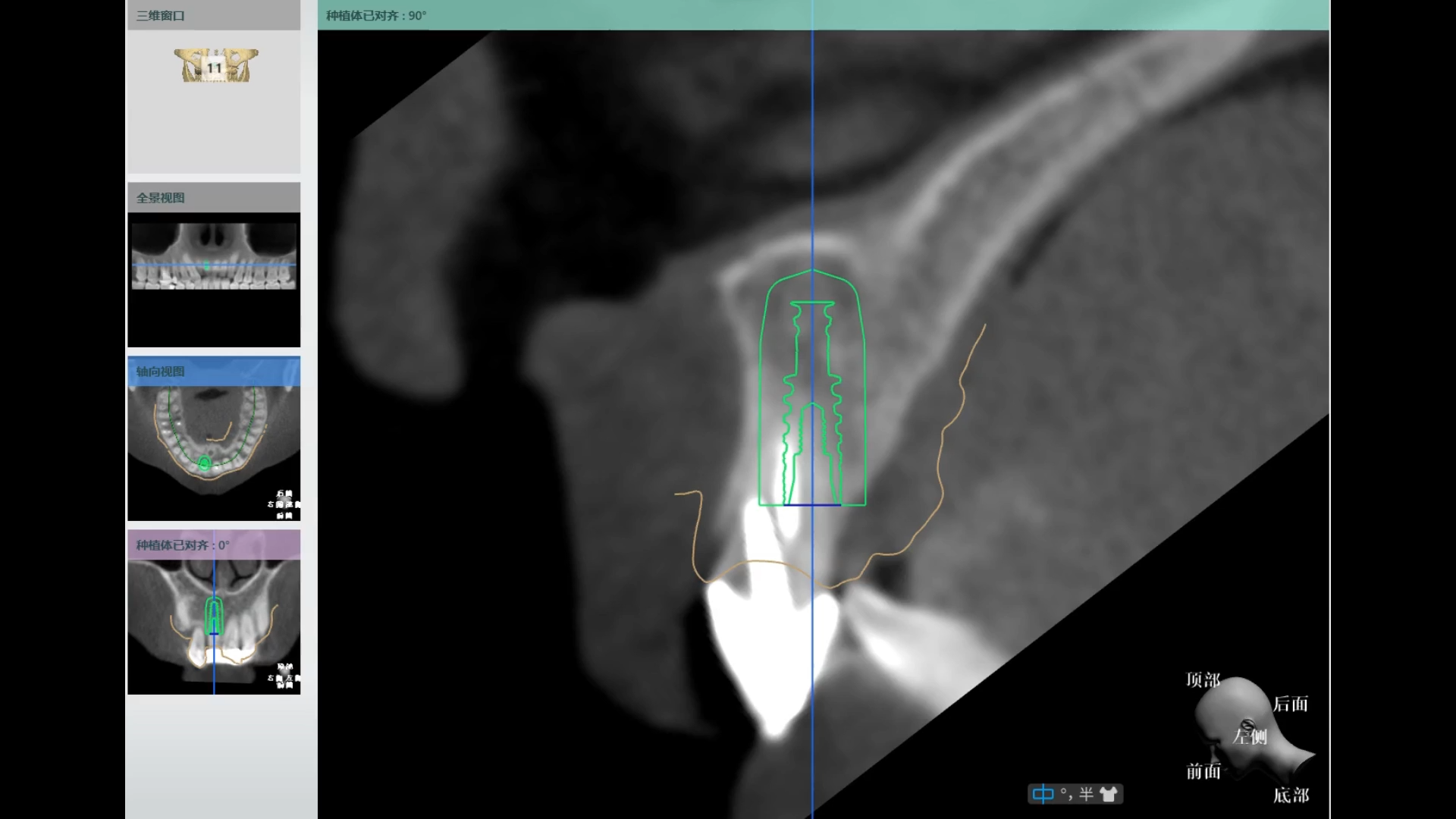 Immediate Extraction and Implantation in Anterior Teeth