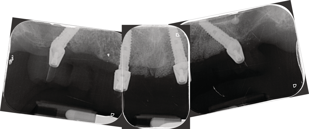 Intraoral Photogrammetry- Is this the end of Plaster impressions?