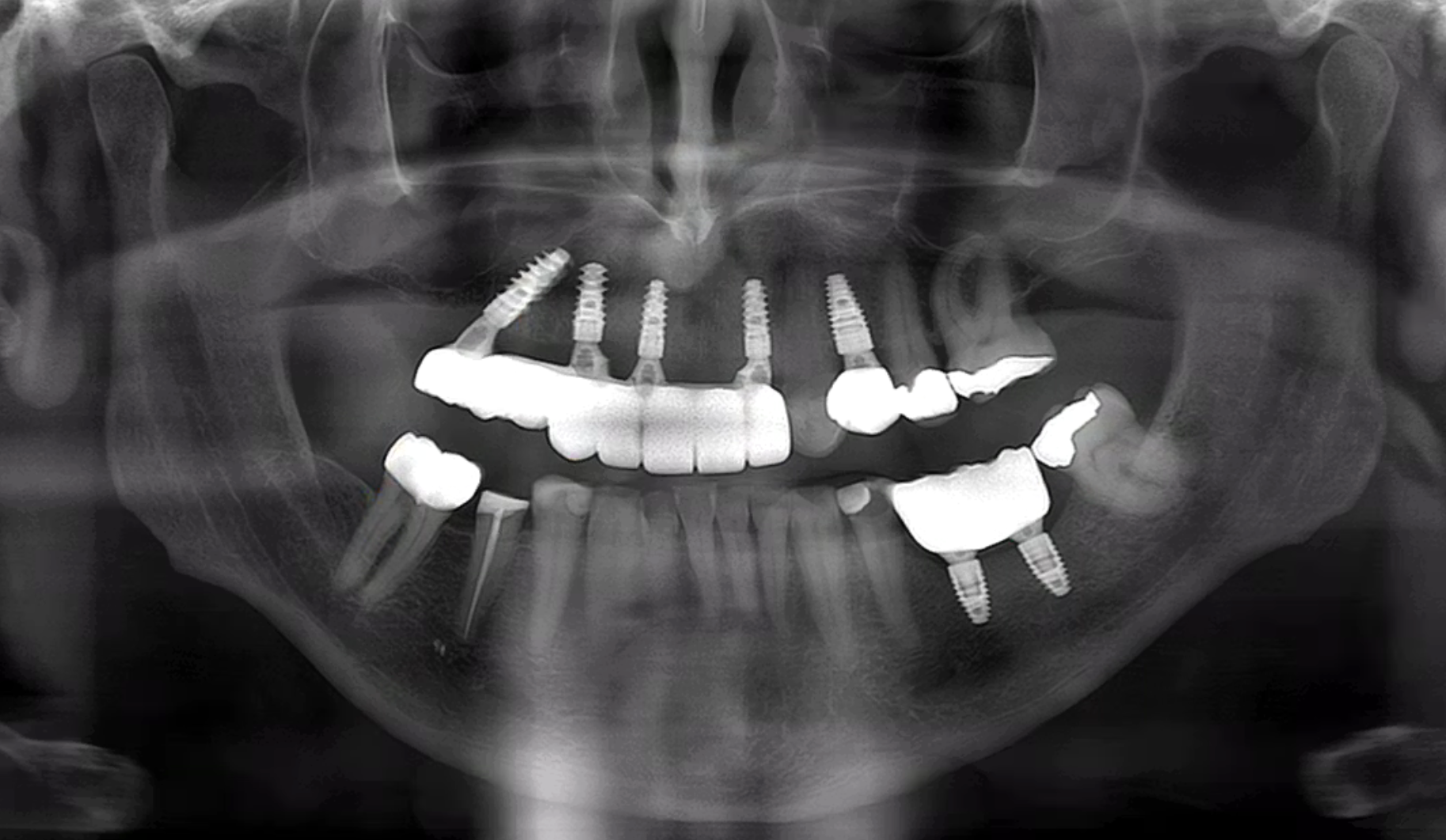 Multiple Implant Restoration with Aoralscan Elite IPG Technology