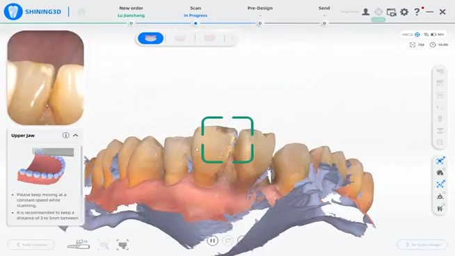 Removable Denture Restoration with Digital Technology