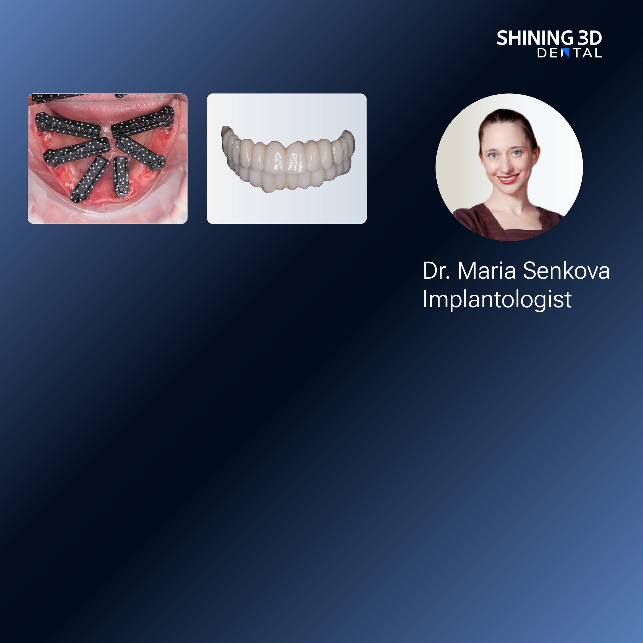 shining 3d dental