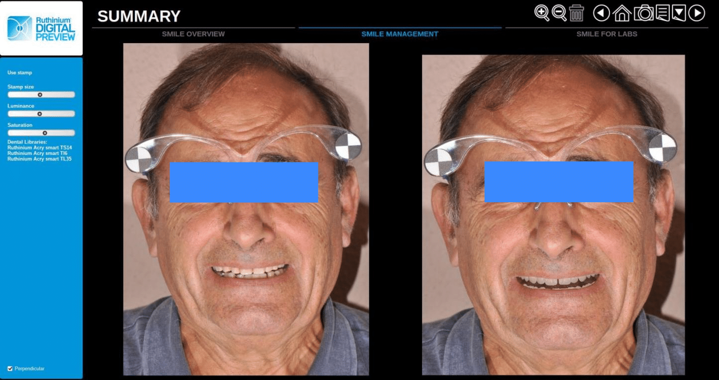 Smile Design and 3D Printed Full Denture