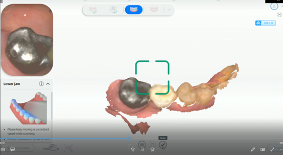 Implant Restorations