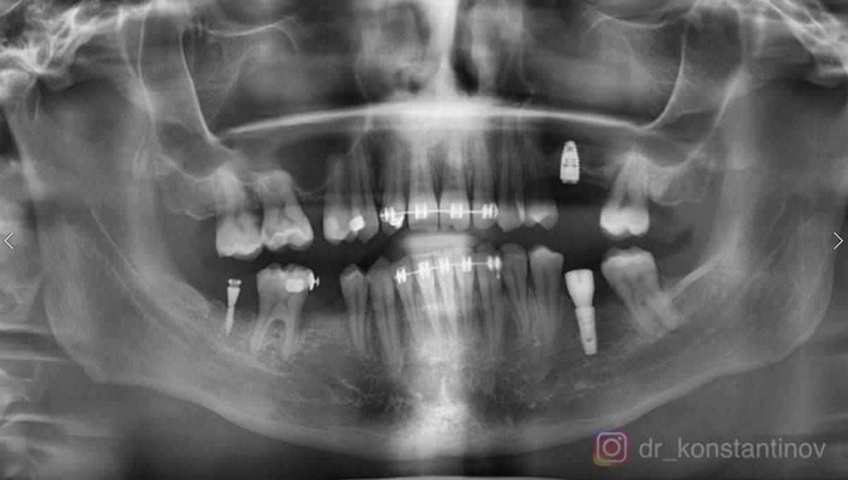 full-digital-surgical-guide8