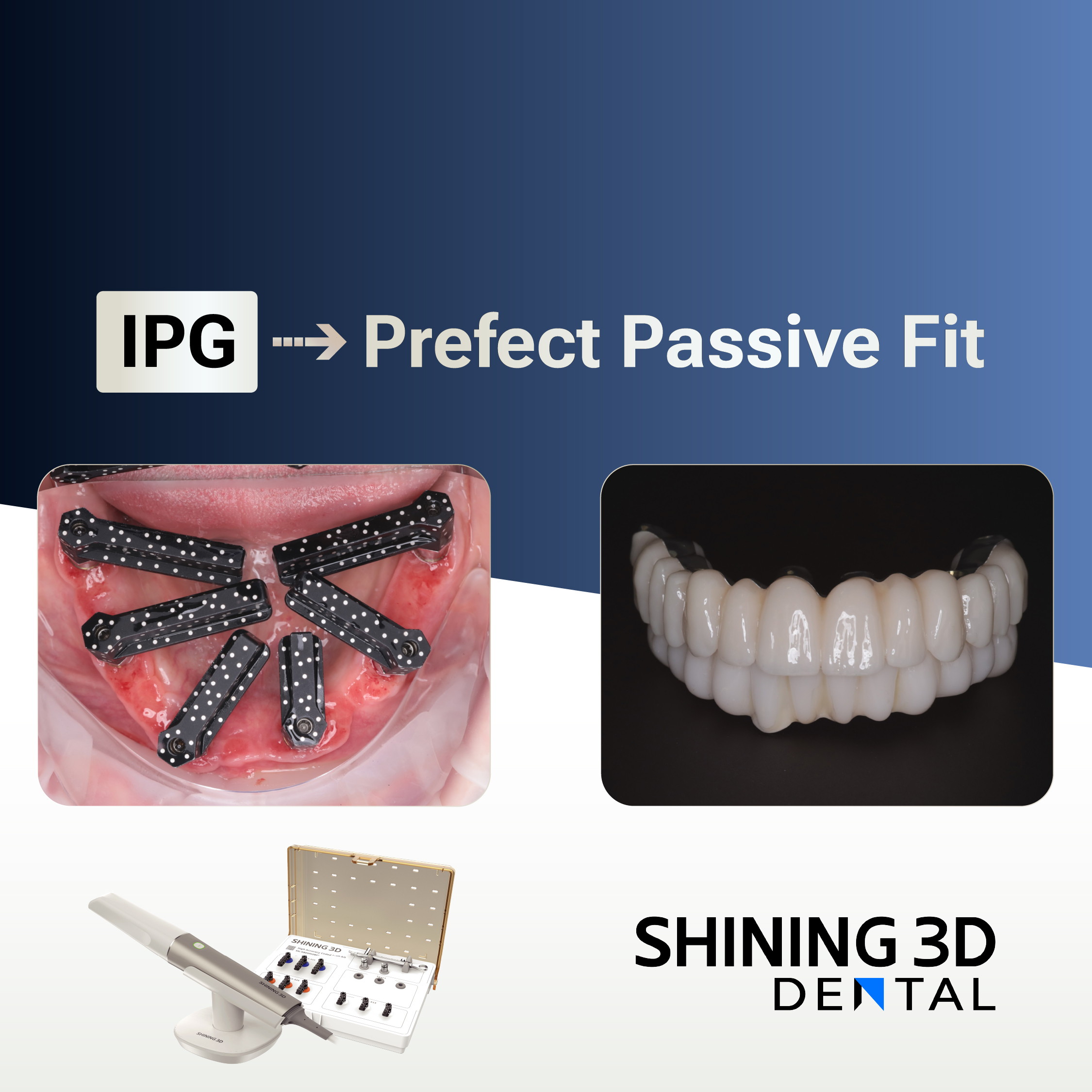 Same-Day Full-Arch Immediate Loading Using Intraoral Photogrammetry (IPG)