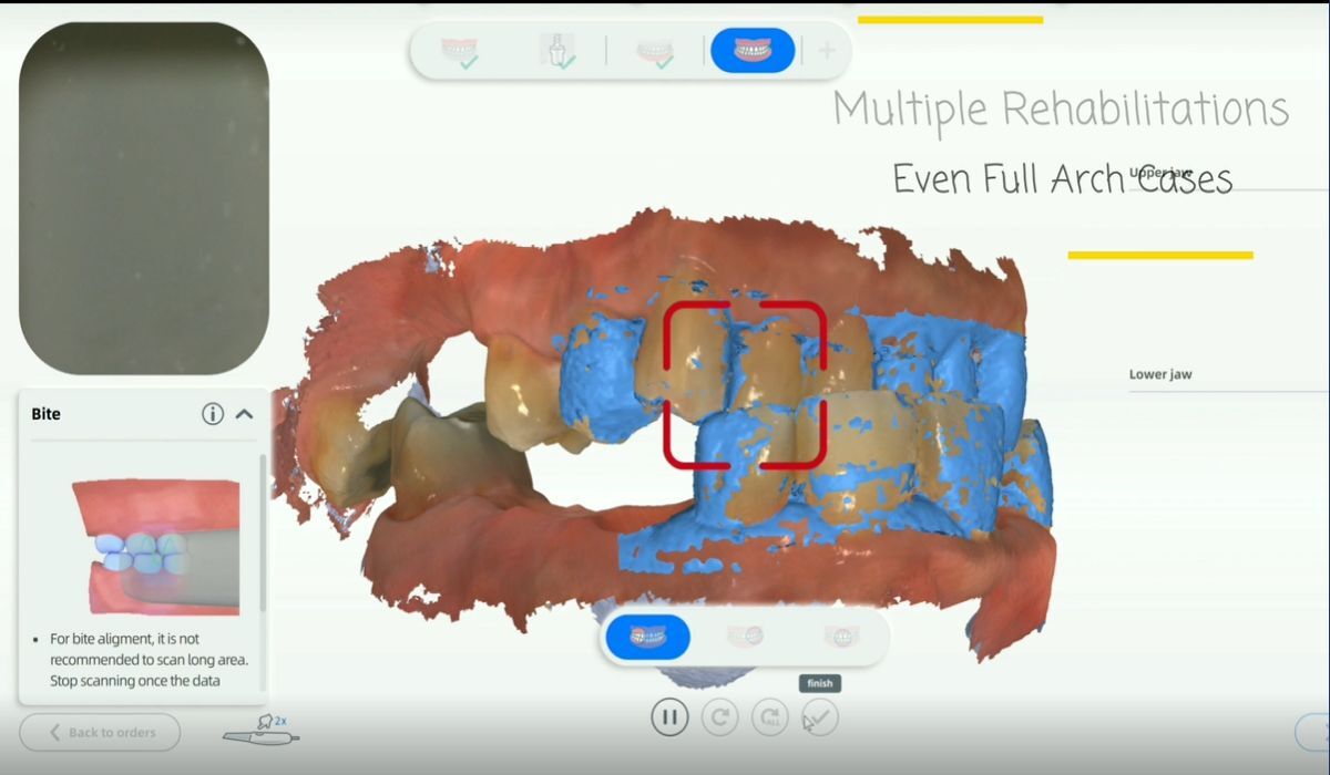 multiple-implant-restoration4