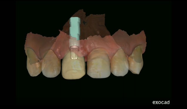 restoration design in exocad
