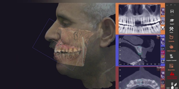 surgery planning for the implant in exocad