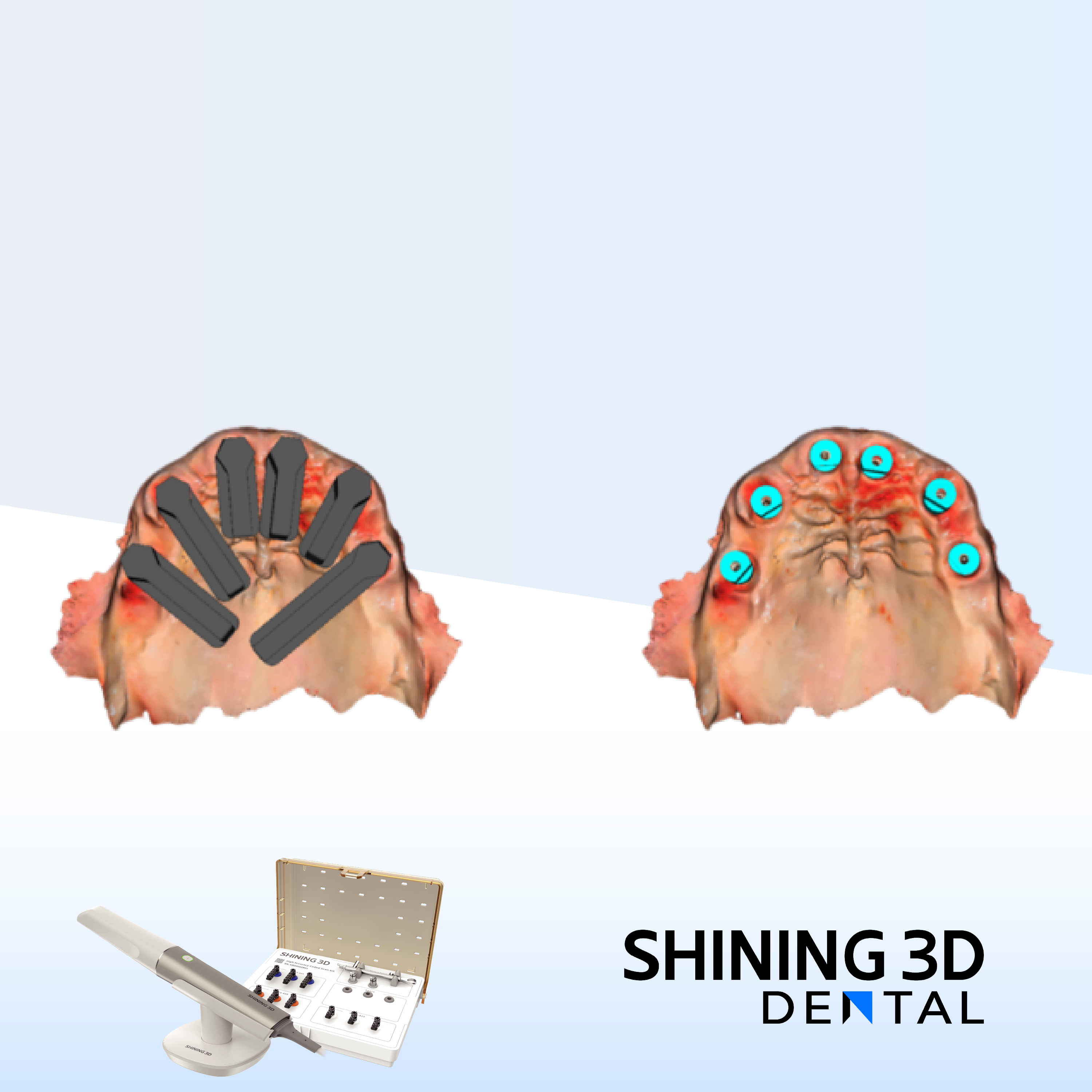 Immediate Implantation with Immediate Loading in a Fully Digital Workflow
